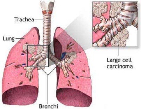 Tắc nghẽn phổi mãn tính là loại bệnh thường gặp ở người già, khiến họ không thể thở được.